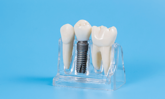 インプラント周囲炎になったらどうすればいい？症状別の対処法を解説