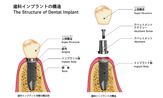 インプラントの種類とは？特徴や基本構造・被せ物の種類など解説